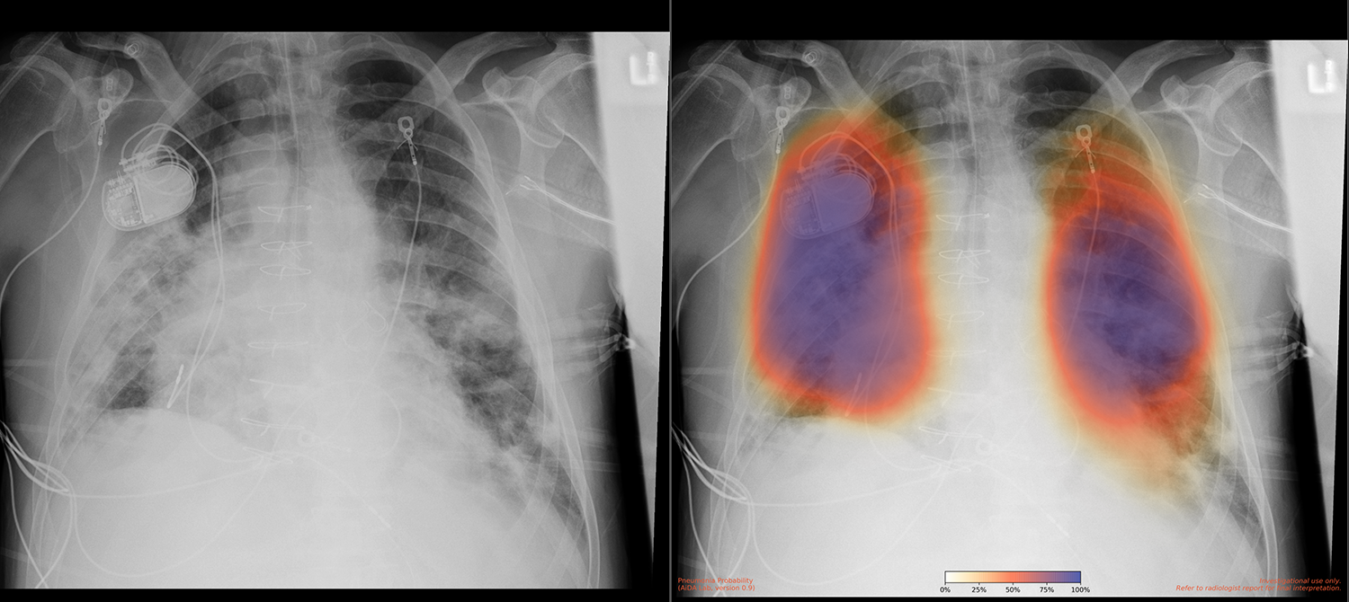 A side-by-side comparison of a chest X-ray image: the left shows a standard medical X-ray with visible internal medical devices, while the right displays the same image with an AI-generated heatmap overlay indicating the probability of pneumonia in different lung regions.